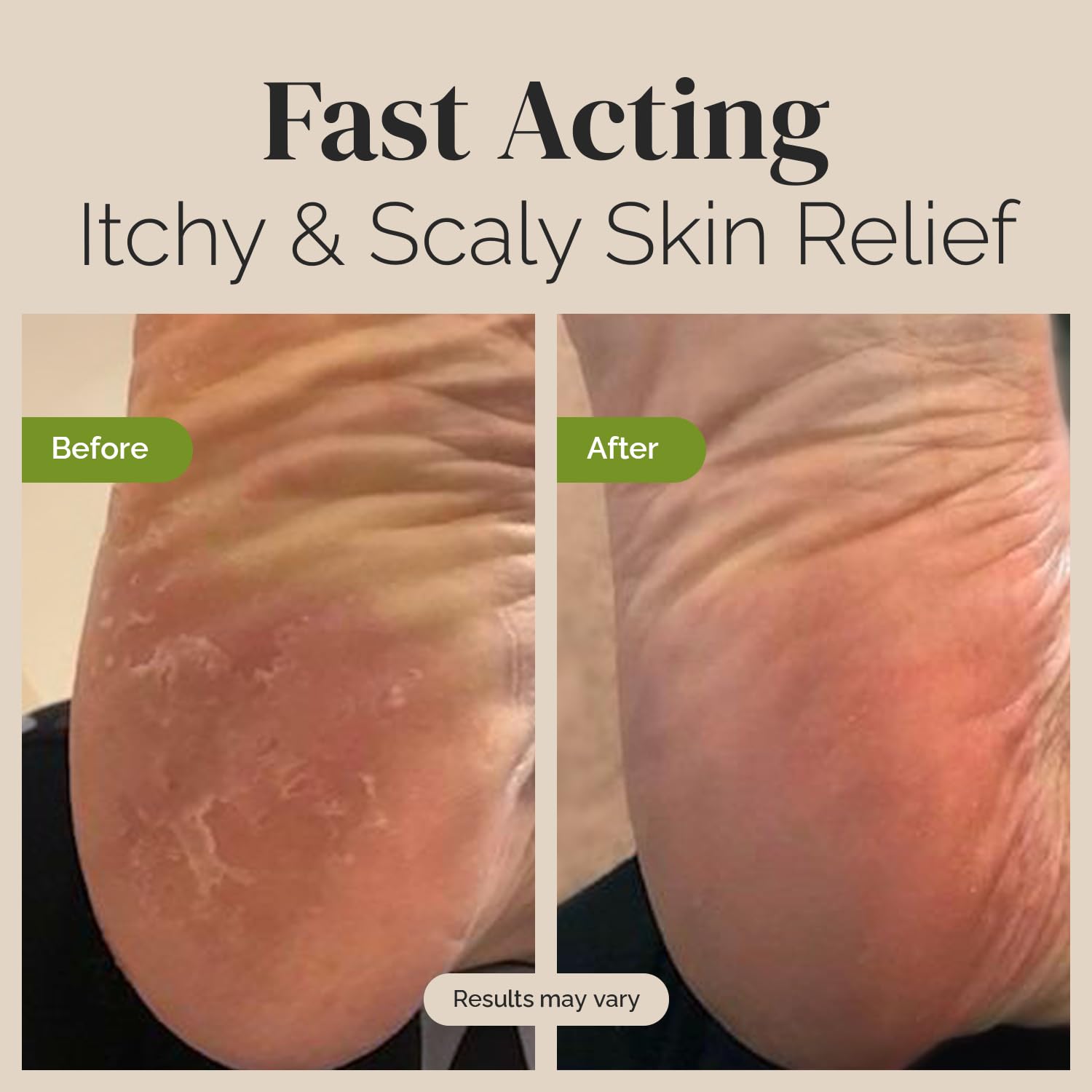 Puriya Extra Strength Tea Tree Oil Balm for Fast Relief of Jock Itch Athletes Foot Ringworm and Dry Itchy Skin Plant Powered Wonder Balm - View 4 of 6