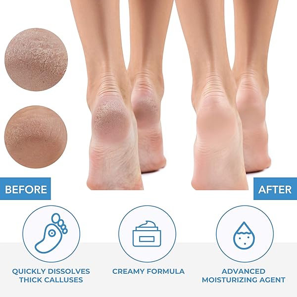 ForPro Professional Collection ForPro Professional Collection Premium Callus No More Callus Remover Fast Acting Formula 32 oz for Smooth Feet - View 5 of 7