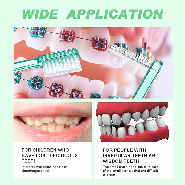 Patelai Orthodontic Toothbrush Set 6 Pieces with Head Protection Covers Double-Ended Interdental Brush for Braces Teeth Cleaning in 4 Colors - View 5 of 8